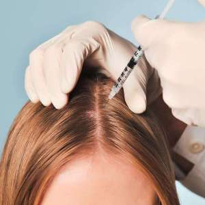 Hair Loss Mesotherapy