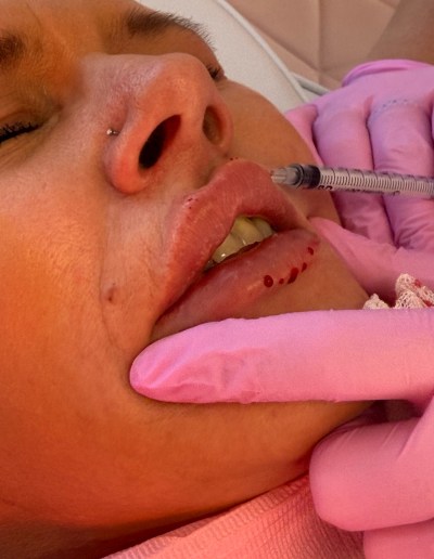 An aesthetics procedure being carried out by an experienced aesthetician